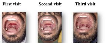 Image result for Erythroplakia roof of mouth