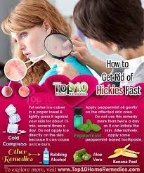 How To Get Rid Of A Hickey After Hours Of Having It | Hickies, Get Rid Of  Hickies, Home Remedies