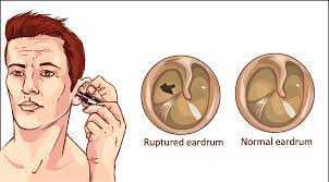 After trying to flush it out, they took a vacuum hose to my ear. Symptoms Of Ruptured Ear Drum Ent Specialist Coimbatore