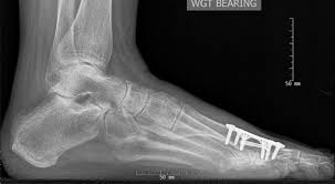 Morton and murray builders and bricklayers provide property. Arthrodesis A Reliable Option For Hallux Rigidus And Failed First Mtp Joint Arthroplasty Consult Qd