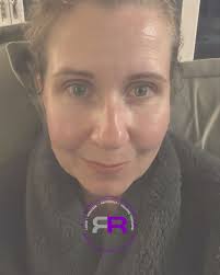 CARBON LASER PEEL ✨️ CARBON Laser Peel is a non-invasive skin treatment  designed to deeply cleanse, exfoliate, and rejuvenate the skin. It's  sometimes called the "Hollywood Peel" because of its popularity with