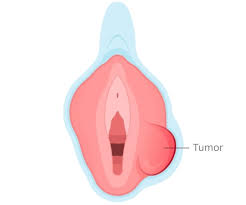 Image result for Vulvar Cancer