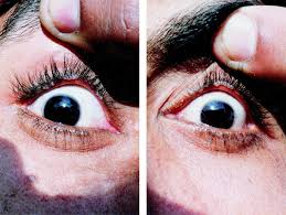 Image result for milium cyst on eyelid