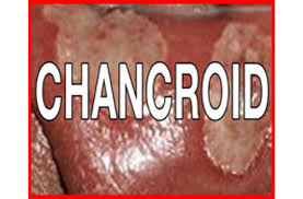 Image result for chancroid
