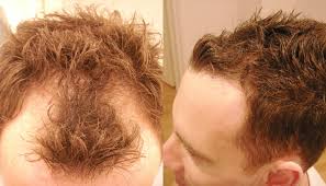 Now let's take a look at the best hair growth products for men and women. Receding Hairline International Hair Studio