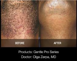 I have an extreme level of ingrown hair and my inner thigh gets black, any suggestions? Laser Hair Removal Moncton Sparkle Lifestyle Medispa