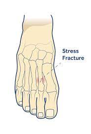 Stress fractures | Shellharbour Podiatry | Your Local Podiatrists