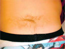 Midline Back Pits Skin Tags Hair Tufts And Other Lesions Visual Diagnosis And Treatment In Pediatrics 3 Ed