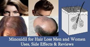 Excess hair growth, especially on the face and chin, is a common symptom of while every woman's experience with pcos is different, excess hair growth as a symptom is very common. What Is Minoxidil Does It Help In Beard Growth Is It Safe