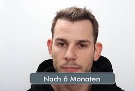 Haartransplantation von Max "MaxaMillion"