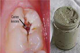 3 Tablespoons Baking Soda 1 Tablespoon Neem Powder 3 Tablespoons Extra Virgin Coconut Oil 1 Tablespoon Xylitol Heal Cavities Homemade Toothpaste Gum Health
