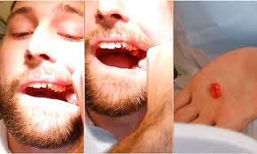 For more information about newtown dental studio in sandton please contact the clinic. Dentistry Student Jesper Ryltoft Pulls Out His Own Wisdom Tooth On Quiet Day At Work Daily Mail Online