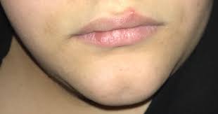 Your dermatologist may prescribe antibiotics to help prevent a secondary bacterial infection. Can Anyone Tell Me What This Bump On My Lip Is Sexual Health Forums Patient