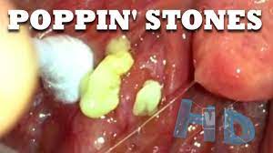 It's a great way to remove them without gagging, and it doesn. Biggest Tonsil Stones Of Reddit One Million Stones Youtube
