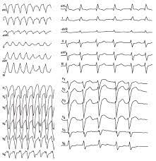 Vikten av att forska på medvetslösa hjärtstoppspatienter. Akut Hjartstopp Janusinfo Se