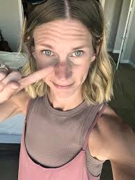 Has anyone else had experience with pre-cancerous spot removal?