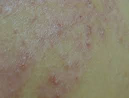 Her body's reaction was so severe that prescribed medications did not reduce the inflammation, she said. Black Henna Tattoo Reaction Dermnet Nz