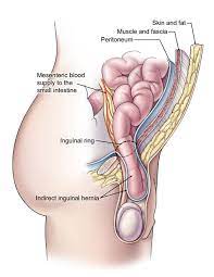 We did not find results for: Hernia Surgery Cleveland Clinic