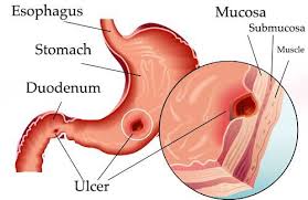 Zifahamu Dalili 20 Za Ugonjwa Wa Vidonda Vya Tumbo Peptic Ulcer Stomach Ulcers Symptoms Ulcer Symptoms