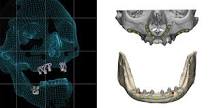 Implantes Personalizados 3D | Clínica Dental Carralero