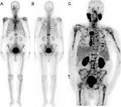 prostate cancer arises in the prostate, a glandthat is located below a man&#x27;s bladder. Comparison Of Bone Uptake In Bone Scan And Ga 68 Psma Pet Ct Images In Patients With Prostate Cancer Bentham Science