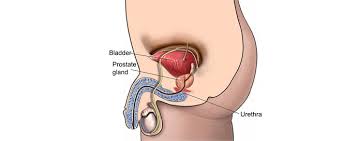 Image result for Radical Prostatectomy