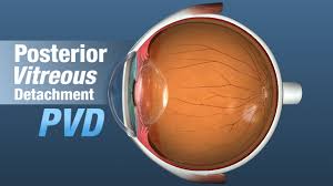 Check spelling or type a new query. Retina Louisville Posterior Vitreous Detachment Bennett Bloom