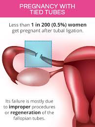 It depends on the type of work you do and how you feel. Chances Of Getting Pregnant After Tubal Ligation Shecares