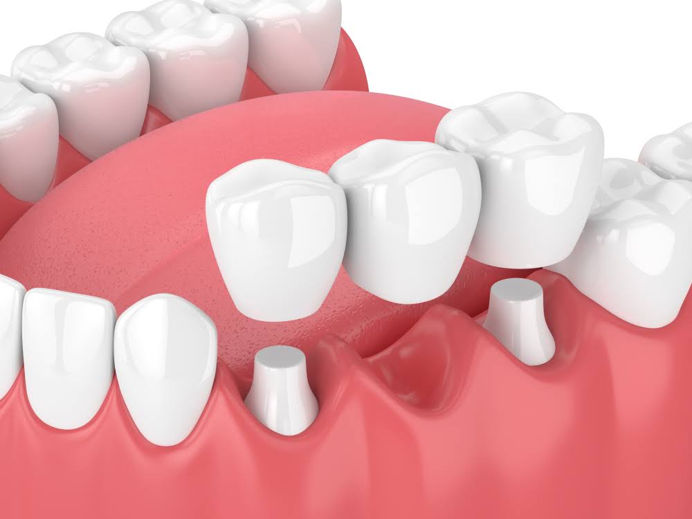 Crowns and Bridges product image