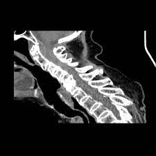Spinal Epidural Hematoma Core Em