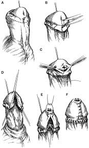 Image result for Chordee