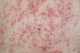 Image result for dermatitis contacta children