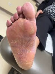Image result for pompholyx soles of feet