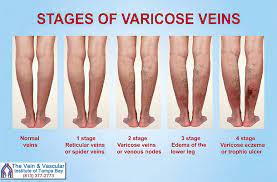 Are The Vein And Vascular Institute Of Tampa Bay Facebook
