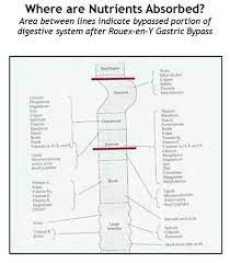Rny Gastric Bypass Where Are Nutrients Absorbed Melting Mama Bbgc Bariatric Bad Girl Gastric Bypass Rny Gastric Bypass Bariatric Surgery
