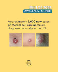Image result for Merkel Cell Carcinoma