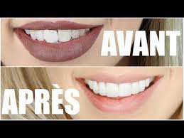 Once the memes were out in the world, journalists began to contact me, and wanted to come to my home to interview me. Mon Sourire Comment J Ai Transforme Mes Dents Youtube