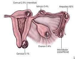 Acest tip de sarcina extrauterina este cunoscuta sub numele de. Ce Este Sarcina Extrauterina Pe Intelesul Tuturor Totul Despre Sarcina