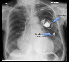 Lung cancer chest xray films. Chest X Ray Of The Patient Showing The Pacemaker In Situ And The Download Scientific Diagram