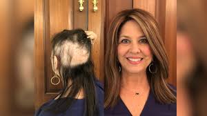 So this week i'm talking about brain radiation, cutting / losing my hair, and some of the therapies and treatments i'm doing at the moment. Hair Loss Doesn T Just Affect Men These Women Turn To Toppers To Find Their Confidence Again Abc News