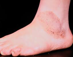 Get warning signs of how to spot a melanoma along with images to help you find melanoma at an early stage, when it is easier to treat and cure. Pigmenterade Nevi Tumoratlas