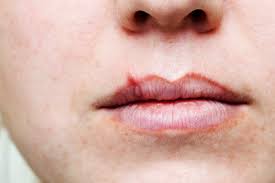 Half of Americans have cold sore virus; 12 percent genital herpes