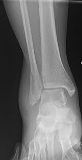 Fibula fracture (anywhere from head or as far down as 6cm above ankle joint). Ankle Fractures Trauma Orthobullets