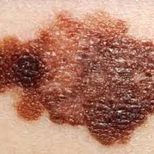 Esto Es Lo Que Significan Las Manchas En La Piel Dependiendo De Su Color Y Forma Manchas Blancas Rojas Rosas Cafes