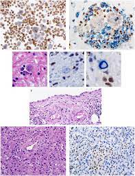 Check spelling or type a new query. Bap1 Brca1 Associated Protein 1 Is A Highly Specific Marker For Differentiating Mesothelioma From Reactive Mesothelial Proliferations Modern Pathology