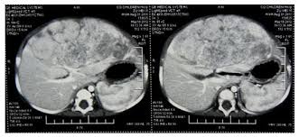 However, as the cancer grows larger, people may notice one or more of these common symptoms. Liver Tumors In Infancy And Children Intechopen