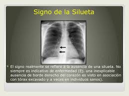 Signos Radiologicos De Torax Radiologia Anatomia Medica Imagenologia
