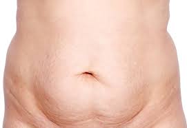 #ivanachapman #diastasisrecti #diastasisrectiinmen #diastasisrectiover35diastasis recti in men over 35 (fix your belly bulge!) // if you're over 35, you're a. The Truth About Diastasis Recti And What You Can Do About It Prenatal Yoga Las Vegas