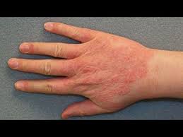как избавиться от экземы на руках в домашних условиях Lechenie Ekzemy Na Rukah I Nogah Kak Vylechit Ekzemu Domashnyaya Adzhika I Ekzema Kak Takoe Vozmozhno Youtube Ruki Maski Dlya Volos Uborka Doma Sovety