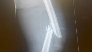 Fundraiser by Marche Smith : Support Jadyn's Recovery Journey